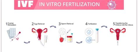 IVF proceso schema
