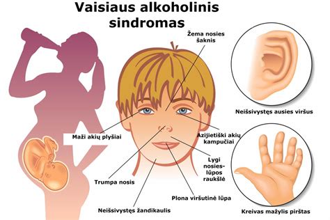 Tipiniai vaisiaus alkoholinį sindromą turinčių vaikų bruožai