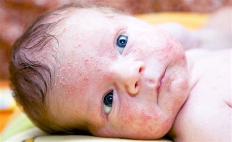 Baltieji naujagimių spuogai (milija)