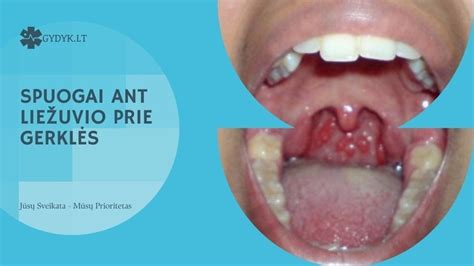 Schematinis gerklės vaizdas, rodantis uždegimo ir skausmo vietas