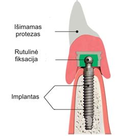Schematinis implantacinio kraujavimo vaizdas