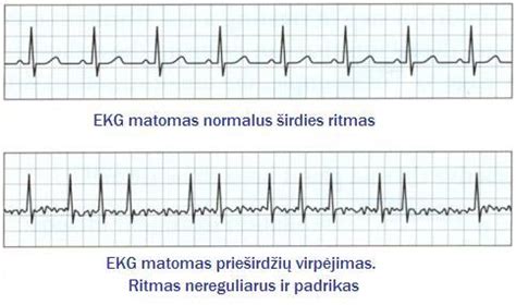 Dažniausi širdies ritmo sutrikimai vaikams schema