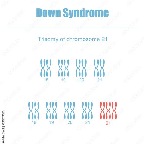 Vaizdinė schema su 21 chromosomos trisomija