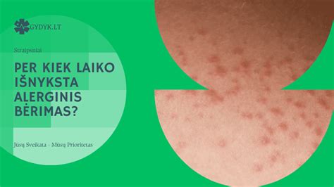 Alerginio bėrimo pavyzdys (dilgėlinė)