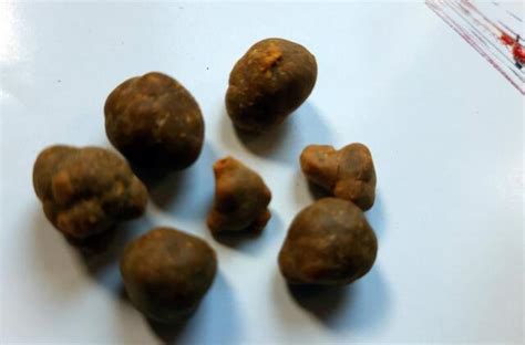 Tulžies pūslės akmenys ultragarsu