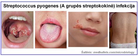 Schema, kaip B grupės streptokokas gali būti perduodamas nuo motinos naujagimiui