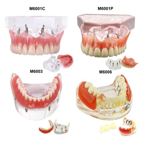 įvairių tipų dantų protezų pavyzdžiai
