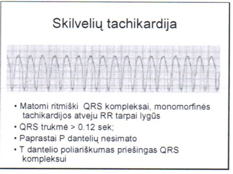 Infografika: Krūtinės ląstos paspaudimų ir įpūtimų santykis vaikams