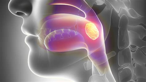 vaiko gerklė su pūlinga angina