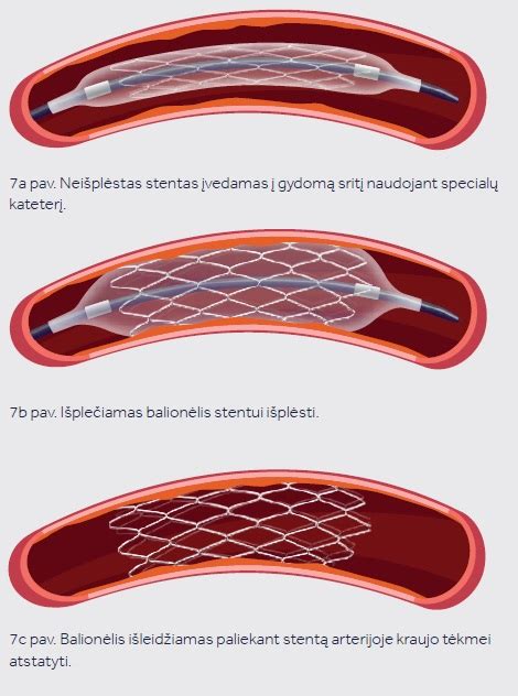 Schema, kaip įvedamas inksto stentas