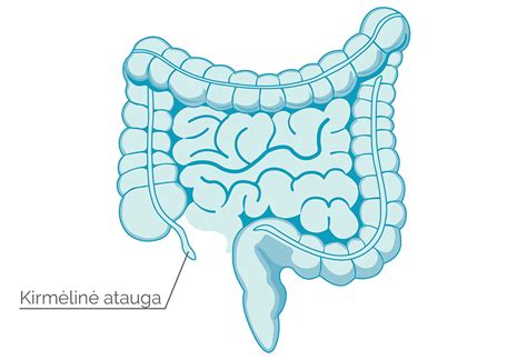 Simptominis apendicito paveikslas
