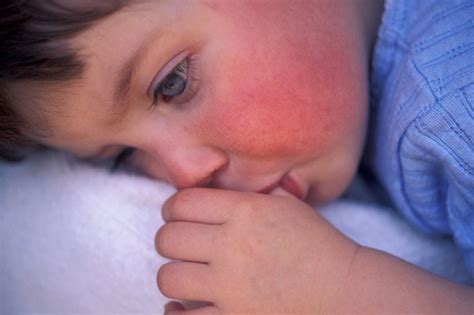 skarlatinos bėrimas