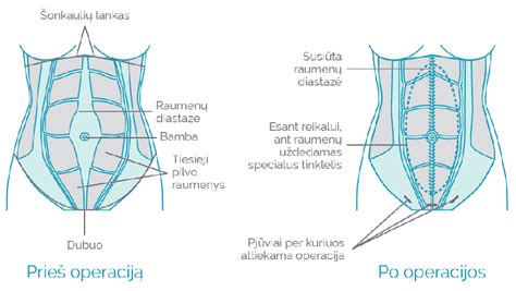 Bambos išvaržos schema