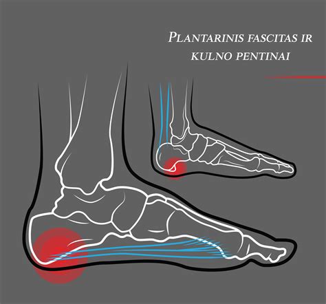 Aukštakulnių poveikis pėdos struktūrai
