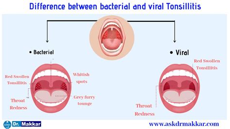 Simptomų palyginimas: virusinis vs. bakterinis tonzilitas