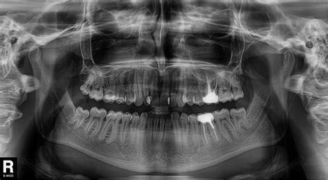 rentgenograma parodanti nekrotizuojantį enterokolitą