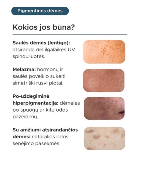 Veido pigmentinės dėmės nėštumo metu