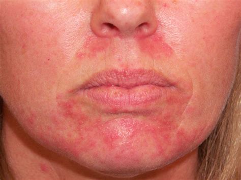 Perioralinis dermatitas gydymas