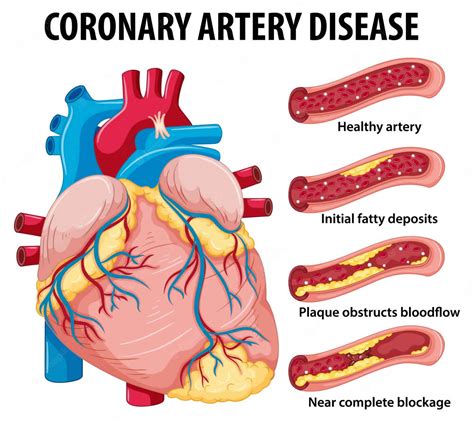 schema of coronary artery disease