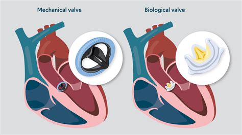 heart valve replacement surgery illustration