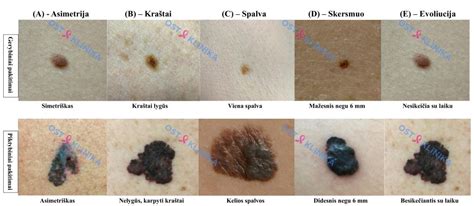 ABCDE taisyklės apgamų tikrinimui