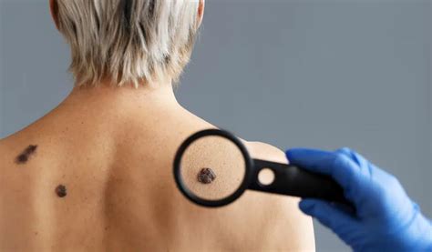 Melanomos ABCDE taisyklė