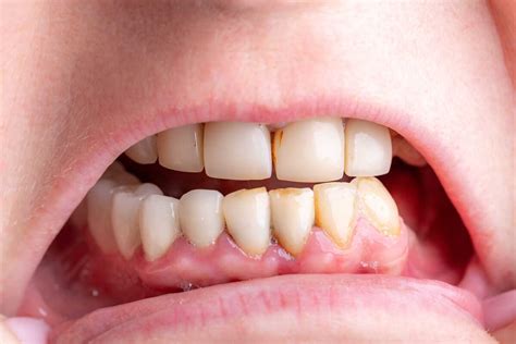 Rūgščių poveikis dantų emaliui