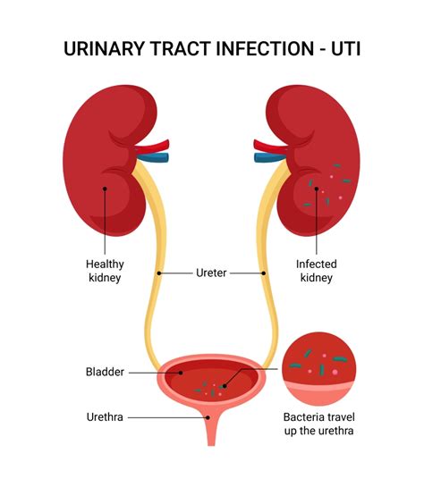 schema of urinary tract infection