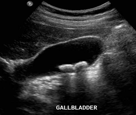 ultrasound of gallstones