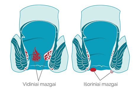 Schema, kaip atrodo hemorojus