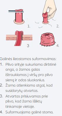 Infografika: kada kreiptis į gydytoją dėl kraujavimo iš tiesiosios žarnos