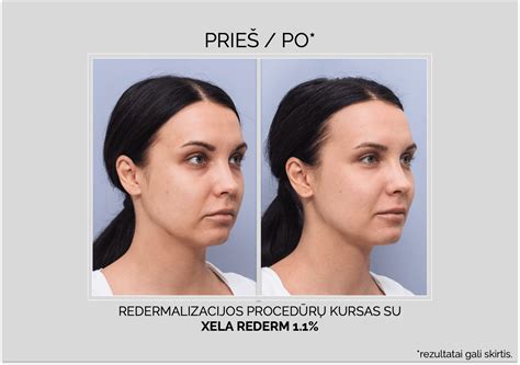 BBL procedūros rezultatai prieš ir po