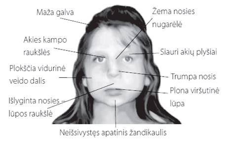 Vaisiaus alkoholinio sindromo (VAS) būdingi veido bruožai