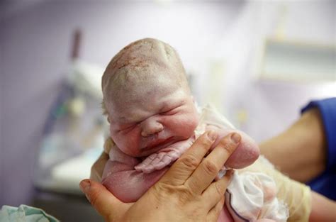 naujagimio galvos traumos gimdymo metu