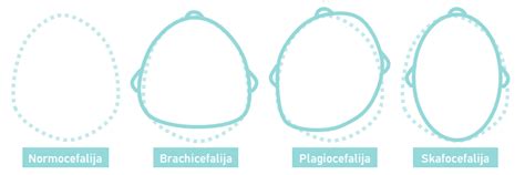 plagiocefalija kūdikio galvos forma