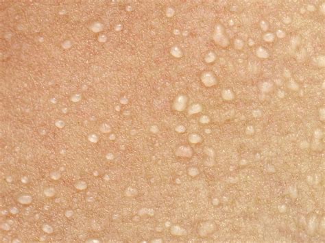 Nuotrauka: Miliaria crystallina - skaidrūs prakaito burbuliukai ant odos