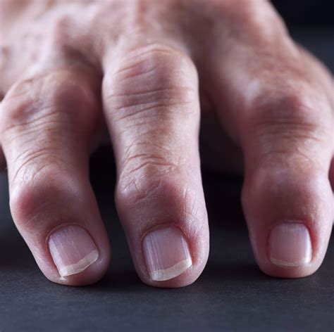 schematinis pūlinio piršto uždegimo pavaizdavimas