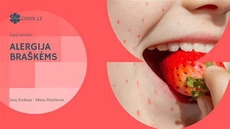 Simptomai alerginės reakcijos į braškes