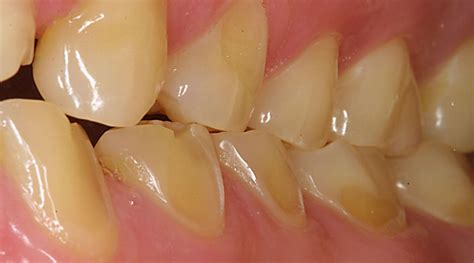 Skaidri grafika, rodanti danties emalio erozijos procesą
