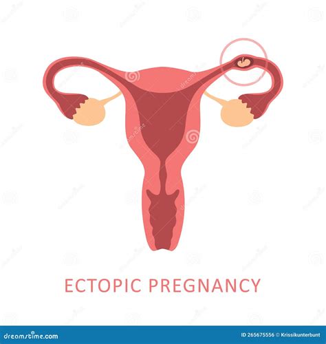 illustration of ectopic pregnancy