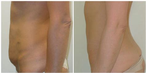 Palyginimas: pilvo forma iki ir po abdominoplastikos
