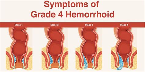 schema of hemorrhoid stages