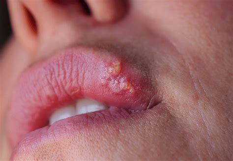 Herpes ant lūpos
