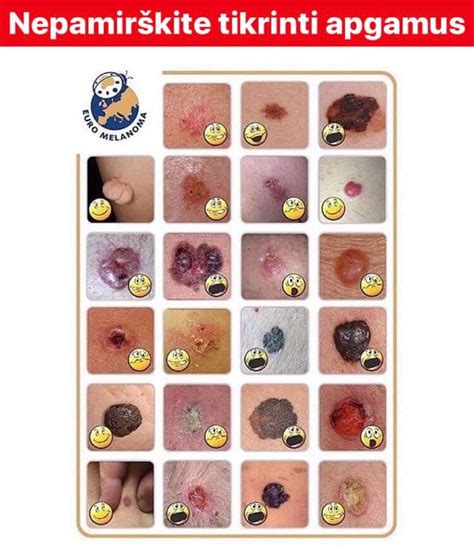 Gydytojo apžiūra, kaip diagnozuojama hemangioma