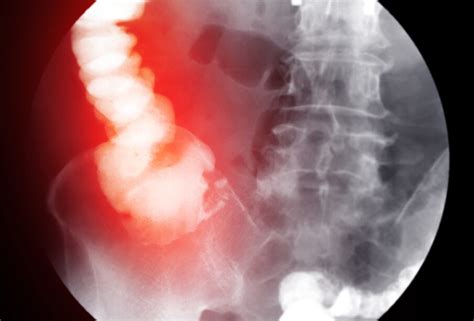 Rentgenogramos nuotrauka, rodanti žarnyno nepraeinamumo požymius