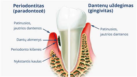 schematinis dantenų uždegimo (gingivito) vystymosi procesas