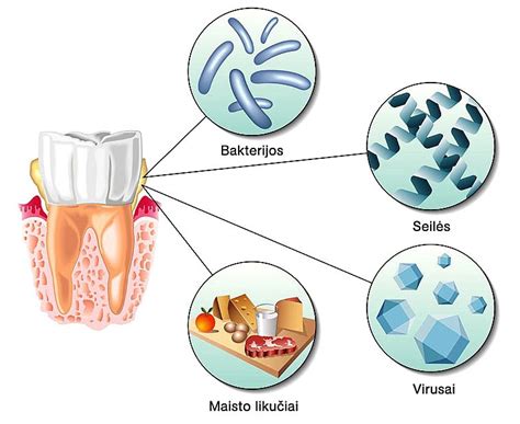 Schema, kaip susidaro dantų akmenys