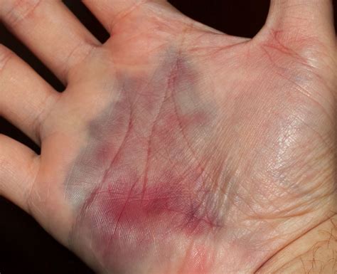 Subchorioninė hematoma ultragarsu