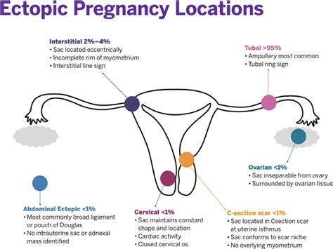 diagram of ectopic pregnancy locations
