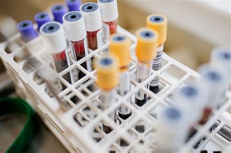 laboratorinė įranga ir kraujo mėginiai HCG tyrimui